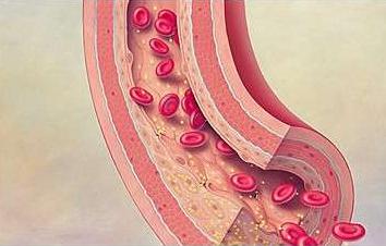 动脉硬化饮食疗法