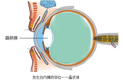 老年性白内障诊断