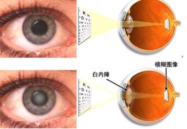 老年人白内障怎么治