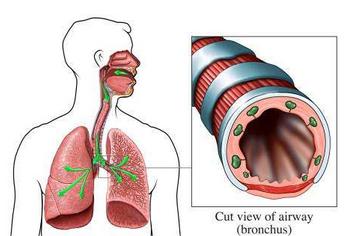 慢性支气管炎用药