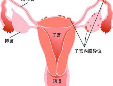 子宫内膜异位症治好