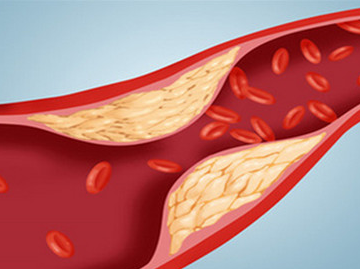 动脉硬化和高血压的关系