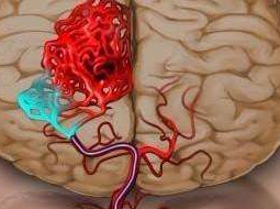 脑出血主要病因是什么