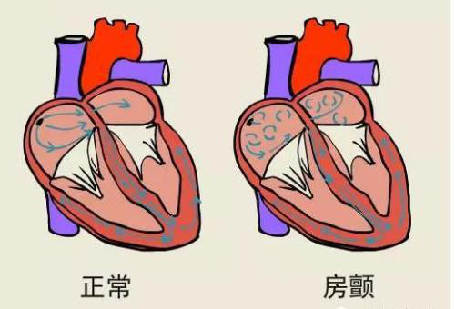 房颤是什么原因引起的