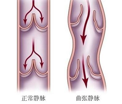 浅静脉炎怎么护理