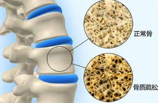 怎样检测骨质疏松