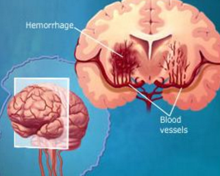 什么原因引起脑出血
