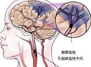 慢性脑中风有什么前兆