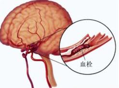 脑血栓前兆有哪些症状