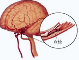 大脑梗塞的治疗