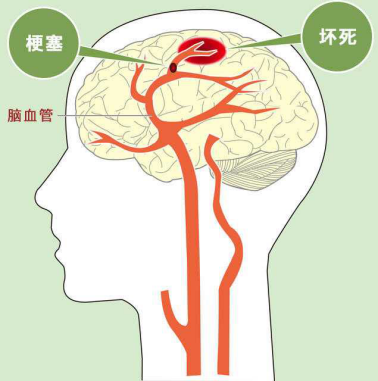 轻度脑梗塞怎么治疗呢