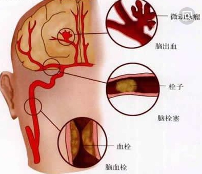 年轻人脑梗死的病因