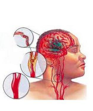 脑梗死最常用的检查是什么，你应该知道
