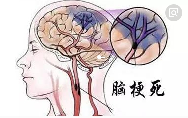 脑梗死最常见的类型