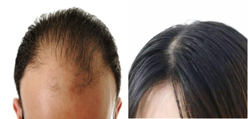 脂溢性脱发原因治疗方法是什么？防脱指南看这里