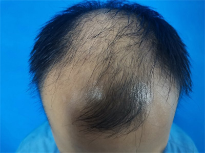 斑秃怎么治疗最快？斑秃脱发用达霏欣米诺地尔多久能恢复？