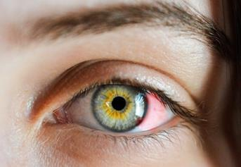角膜炎可以用眼药水吗？告诉你答案