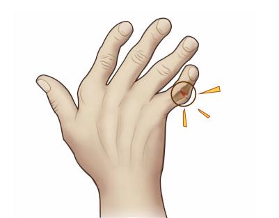 手指类风湿早期症状有哪些？注意这些类风湿的“信号”！
