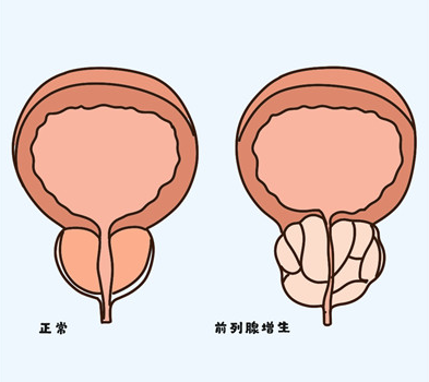 前列腺增生是怎么回事？前列腺增生伴高血压患者服用坦洛新有什么影响吗？