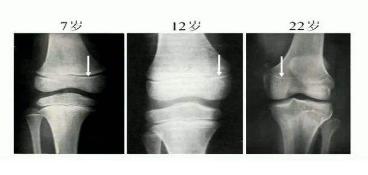 怎么判断骨骺线有没有闭合