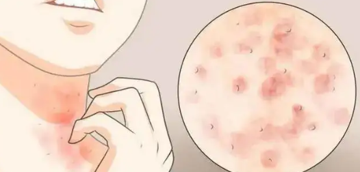 皮肤病中的神经性皮炎和湿疹你知道怎么区分吗